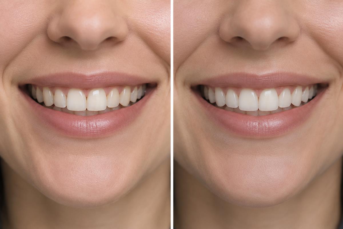 Ejemplo conceptual de estética dental